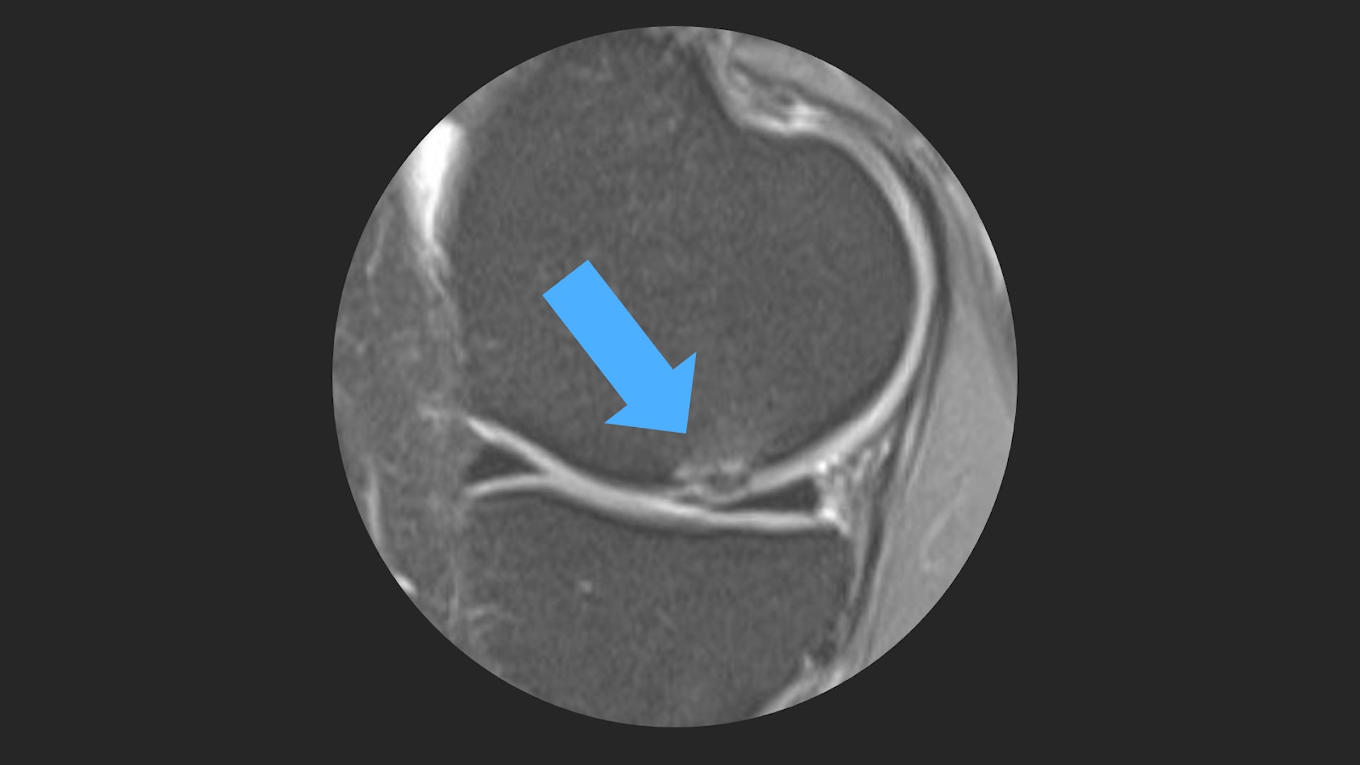 AutoCart™ Procedure for Treatment of Failed Microfracture