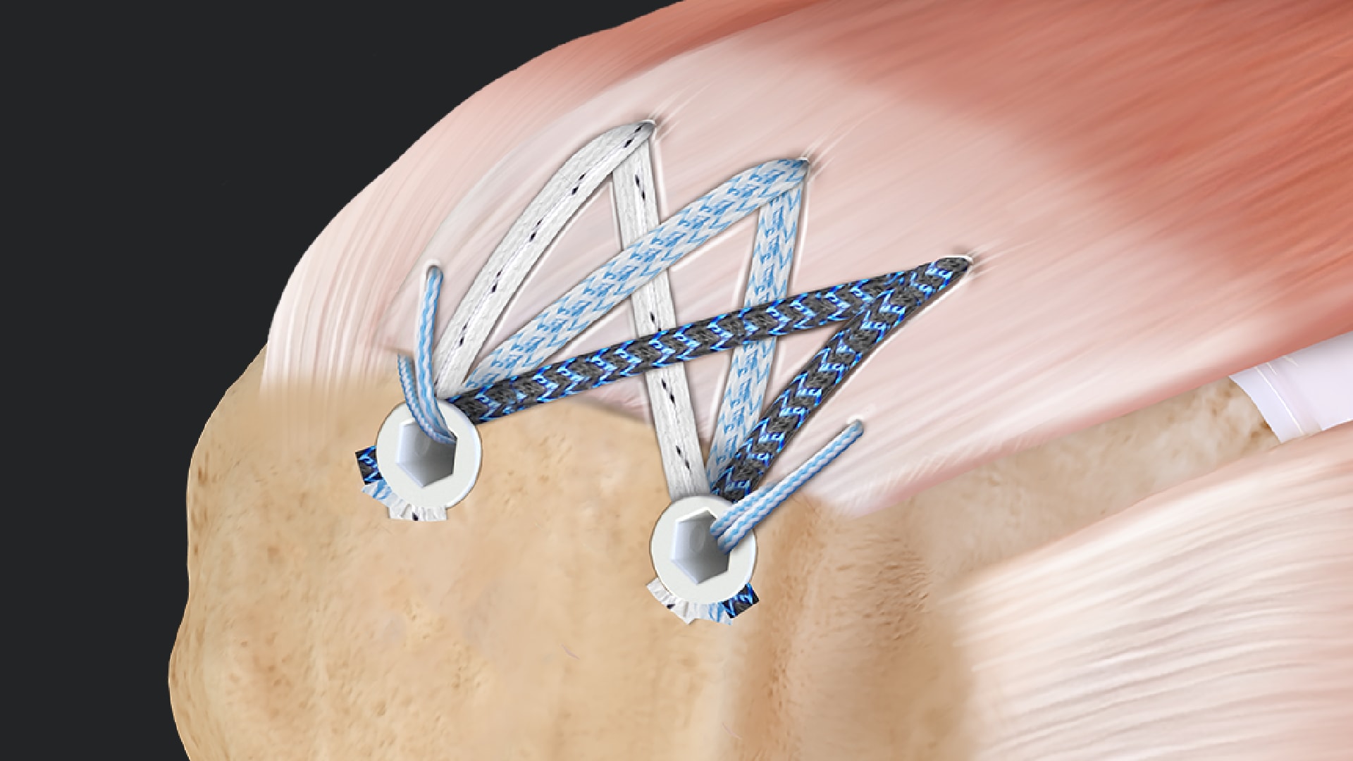 FiberTak® SpeedBridge™ RCR With 2.6 FiberTak RC Anchors for Delaminated Rotator Cuff Tears