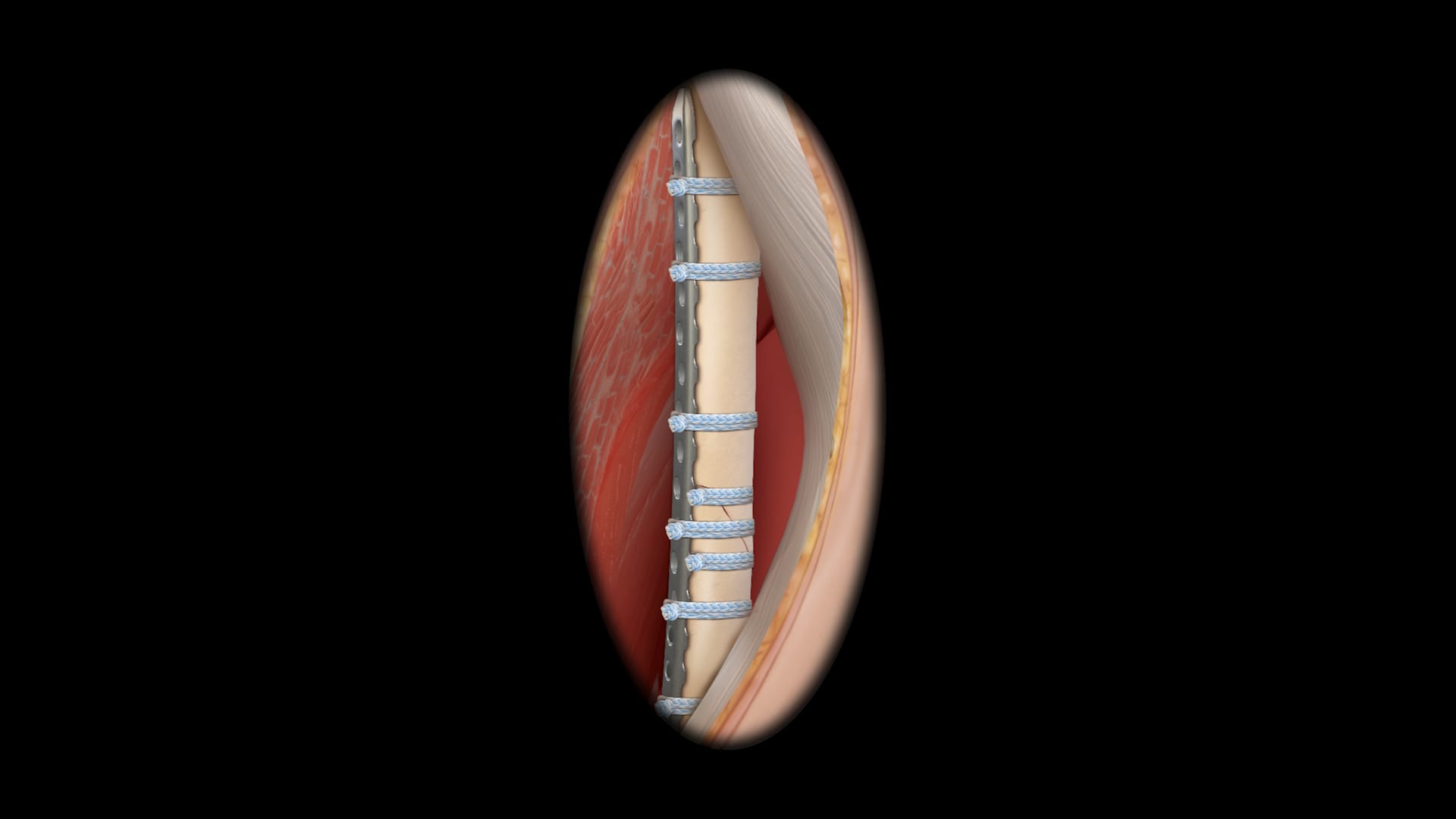 Periprosthetic Femur Fracture With FiberTape® Cerclage and Single-Use Instrumentation 