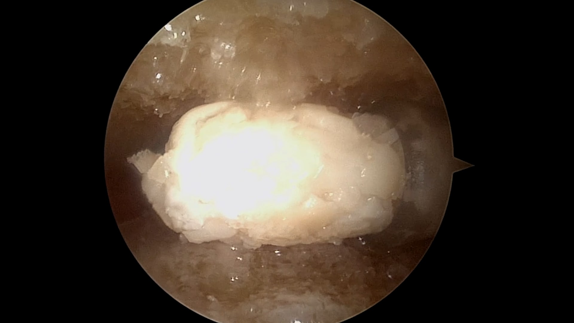 Foot and Ankle Arthroscopic Arthrodesis Augmented Using the GraftNet™ Device