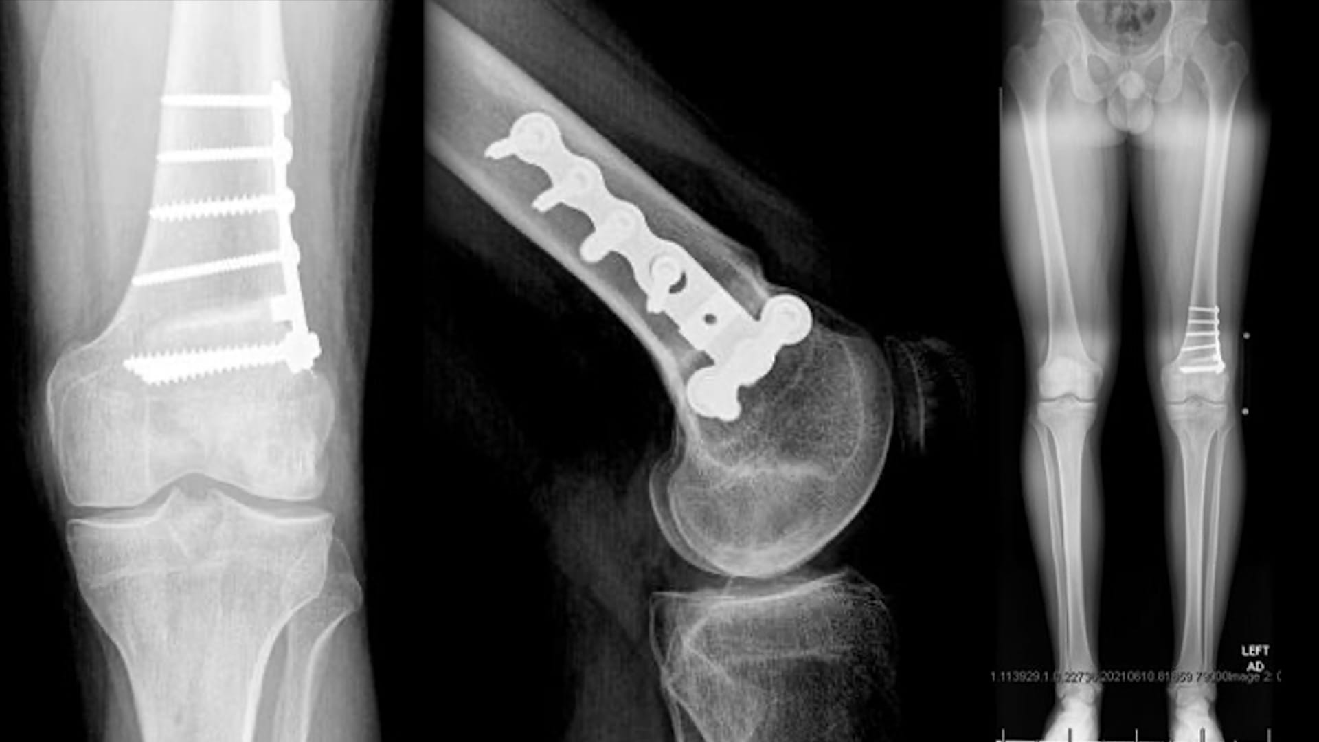 Arthrex Lateral Meniscal Allograft Transplantation With Distal