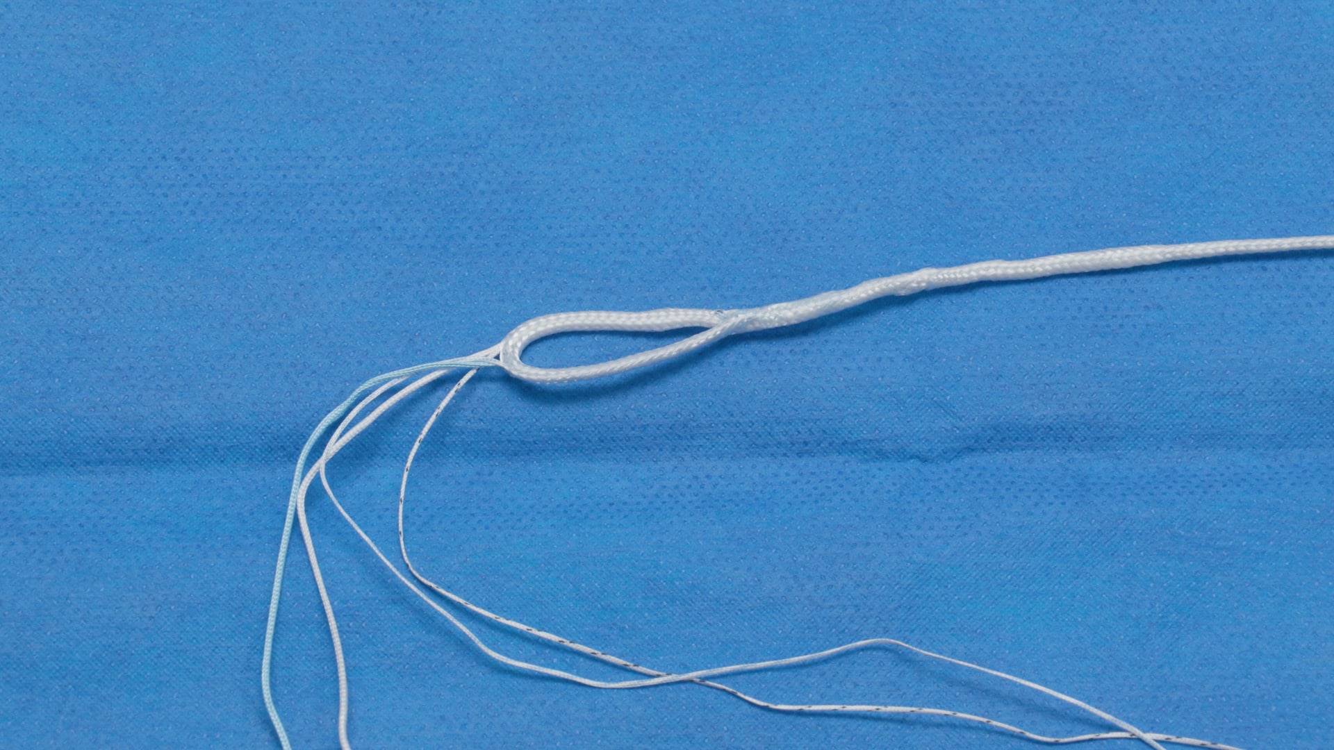 Meniscal Root Repair Using the SutureLoc™ Implant