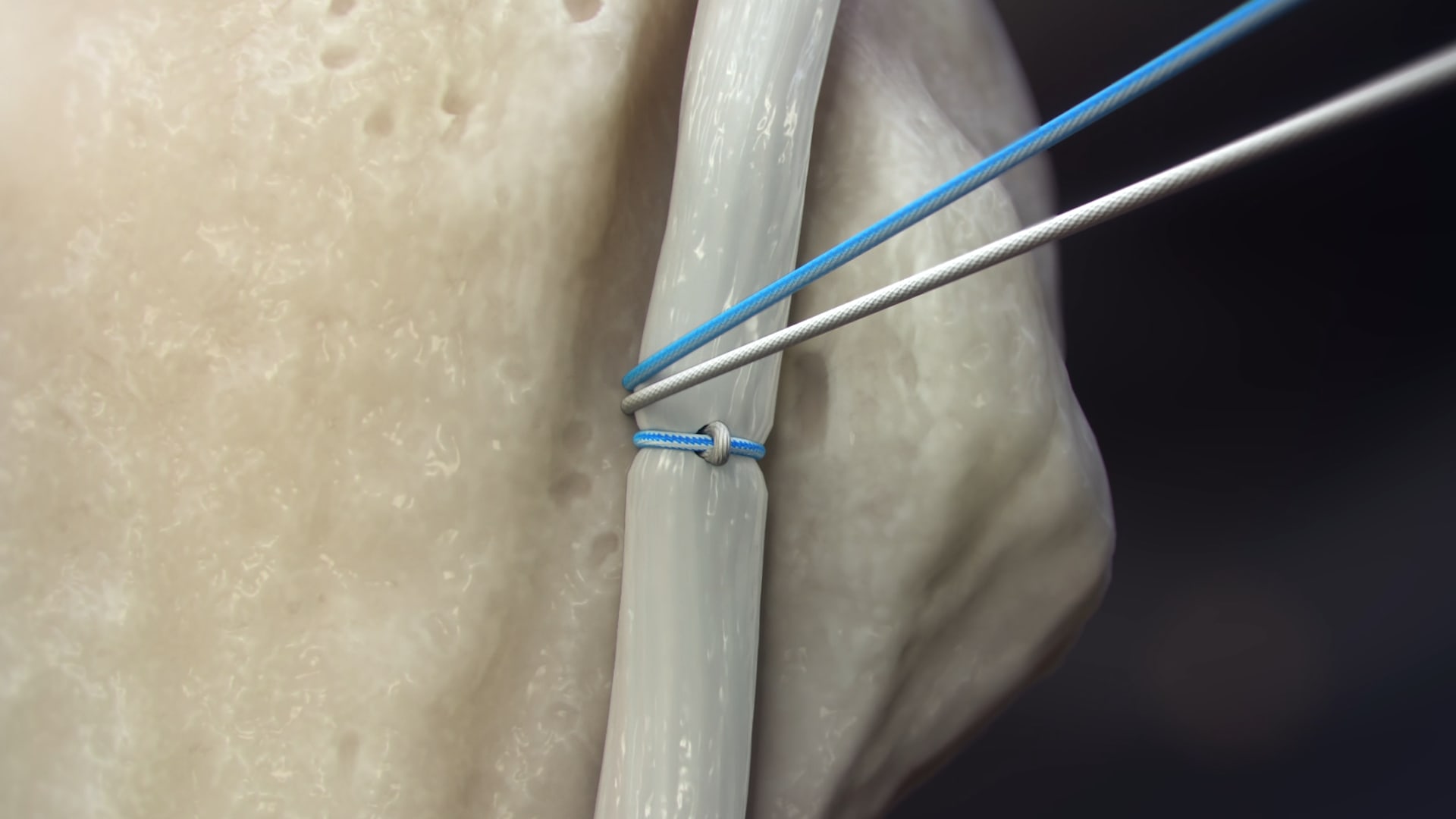 Suprapectoral Onlay Biceps Tenodesis Using the Knotless FiberTak® Biceps Implant System