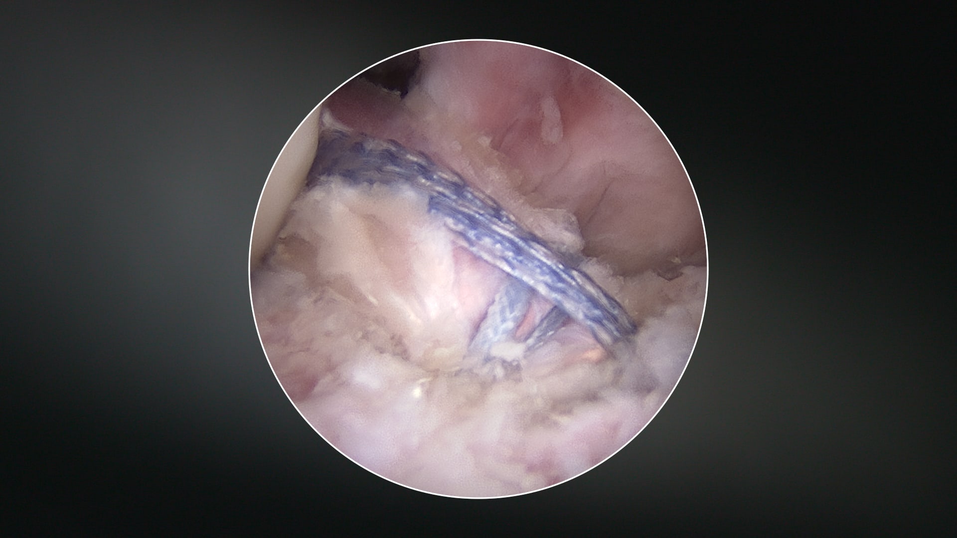 QuadLink™ ACL Reconstruction With LET Using Knee FiberTak® FiberStaple™ Technique