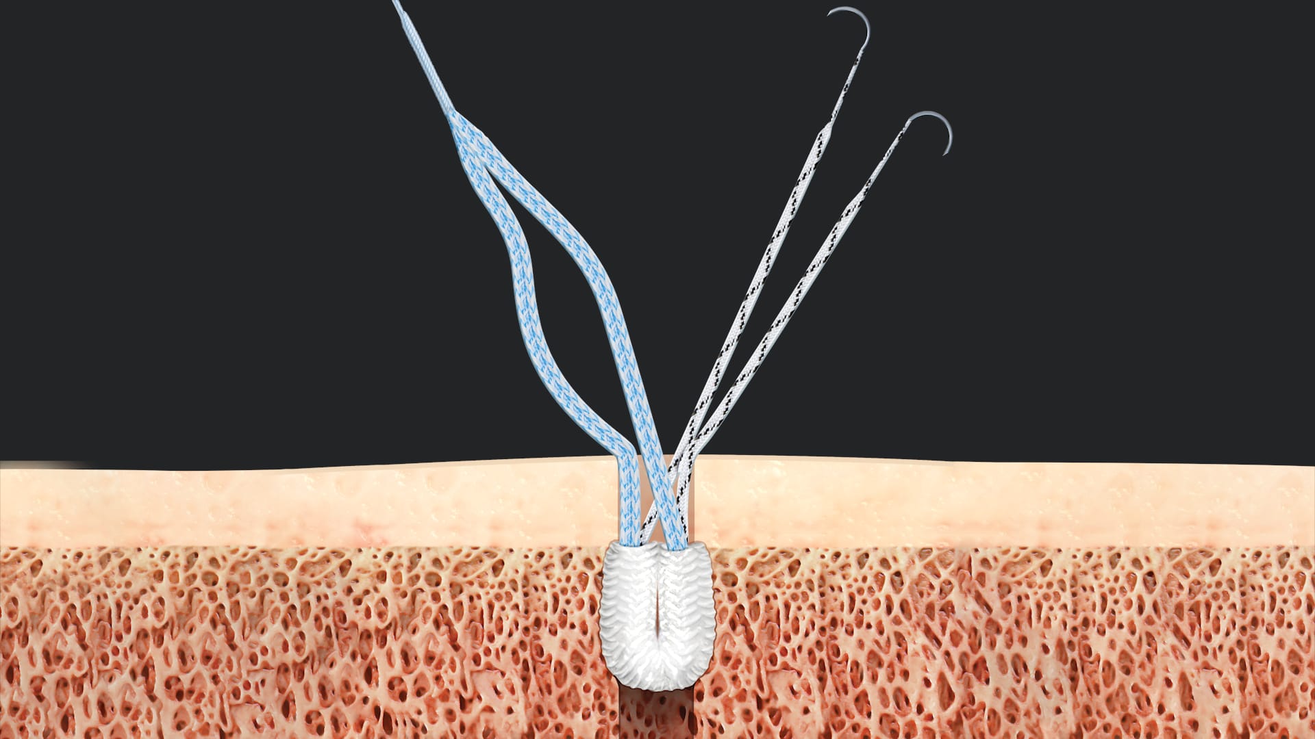 Midsubstance Patellar Tendon Repair Using Knee FiberTak® Anchors