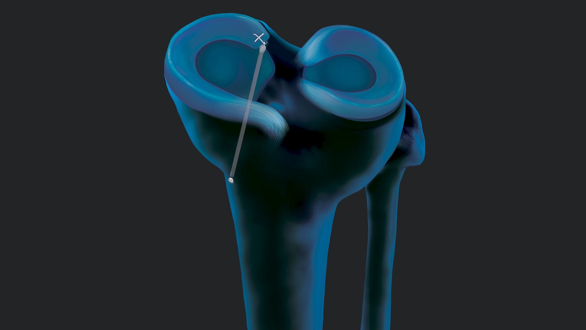 Medial Meniscus Root Repair Using the SutureLoc™ Implant: Early Outcomes and Clinical Rationale