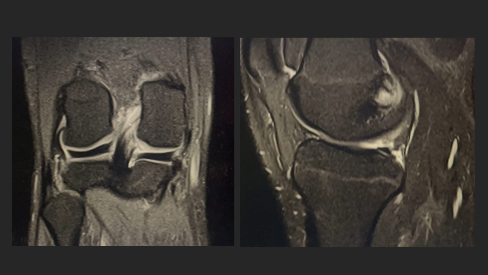 All-Inside Longitudinal Medial Meniscus Repair Using the FiberStitch™ All-Suture Implant