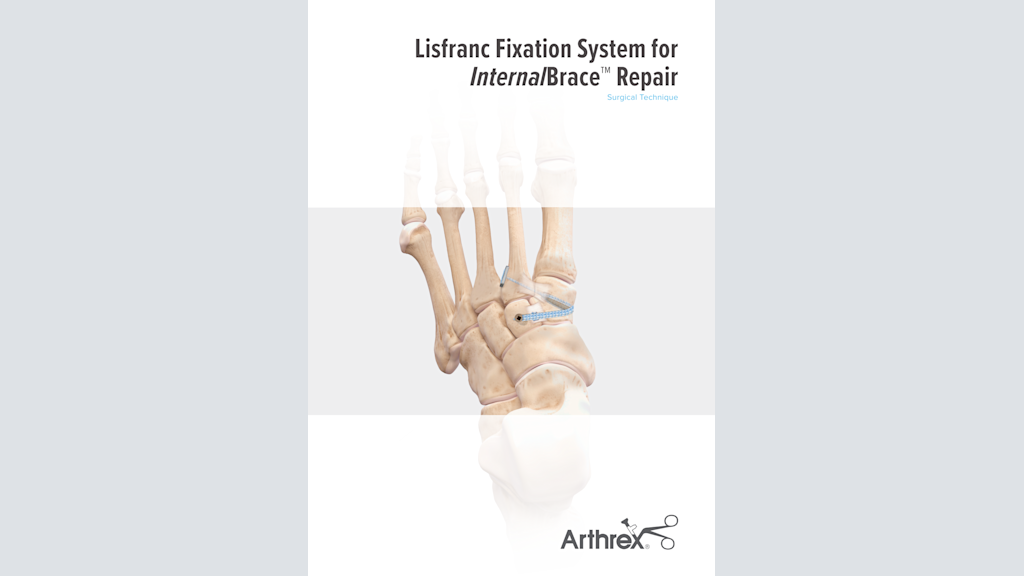 Lisfranc Fixation System for InternalBrace™ Repair