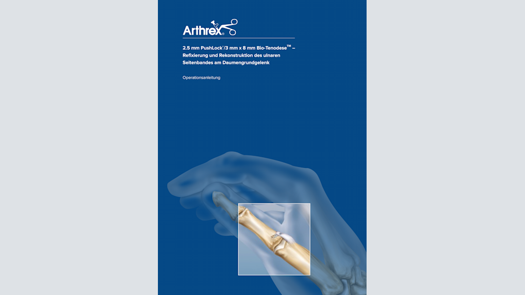 Arthrex - 2.5 mm PushLock® Thumb Collateral Ligament Repair