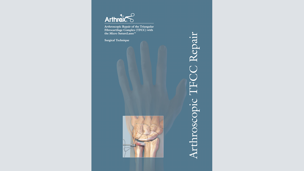 Arthroscopic Repair of the Triangular Fibrocartilage Complex (TFCC) with the Micro SutureLasso™