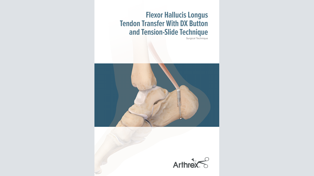 Flexor Hallucis Longus Tendon Transfer With DX Button and Tension-Slide Technique