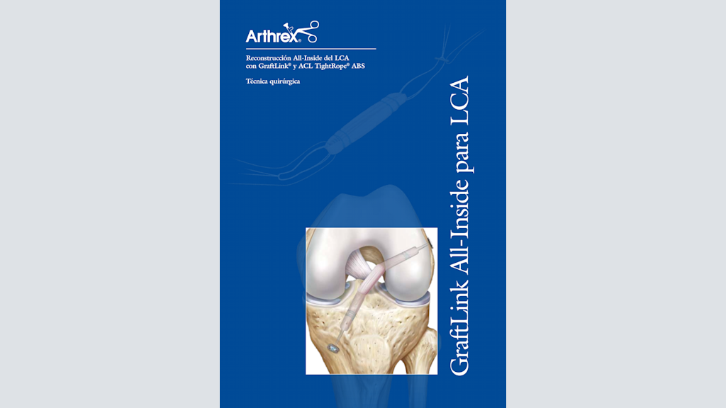 Reconstrucción All-Inside del LCA con GraftLink® y ACL TightRope® ABS