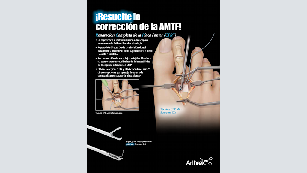 ¡Resucite la corrección de la AMTF! - Reparación Completa de la Placa Pantar (CPR™)