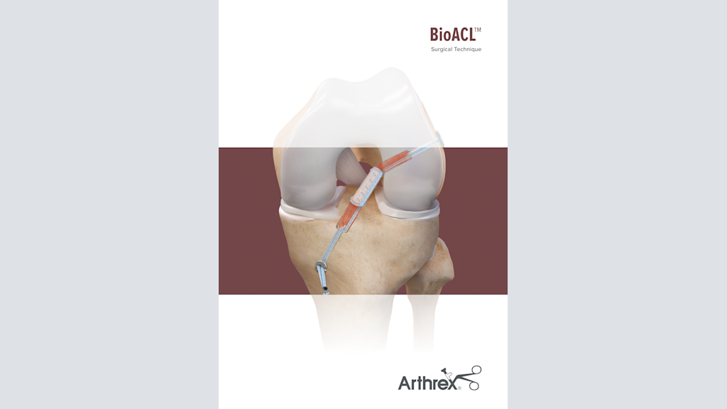 Arthrex Bioacl邃 Technique