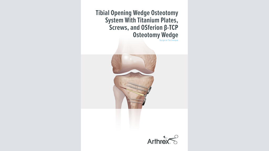 Tibial Opening Wedge Osteotomy System With Titanium Plates and Screws and OSferion β-TCP Osteotomy Wedge