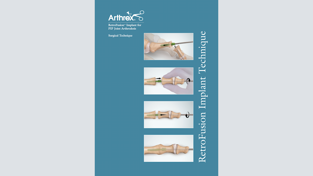Arthrex RetroFusion™ PIP Joint Arthrodesis Implant