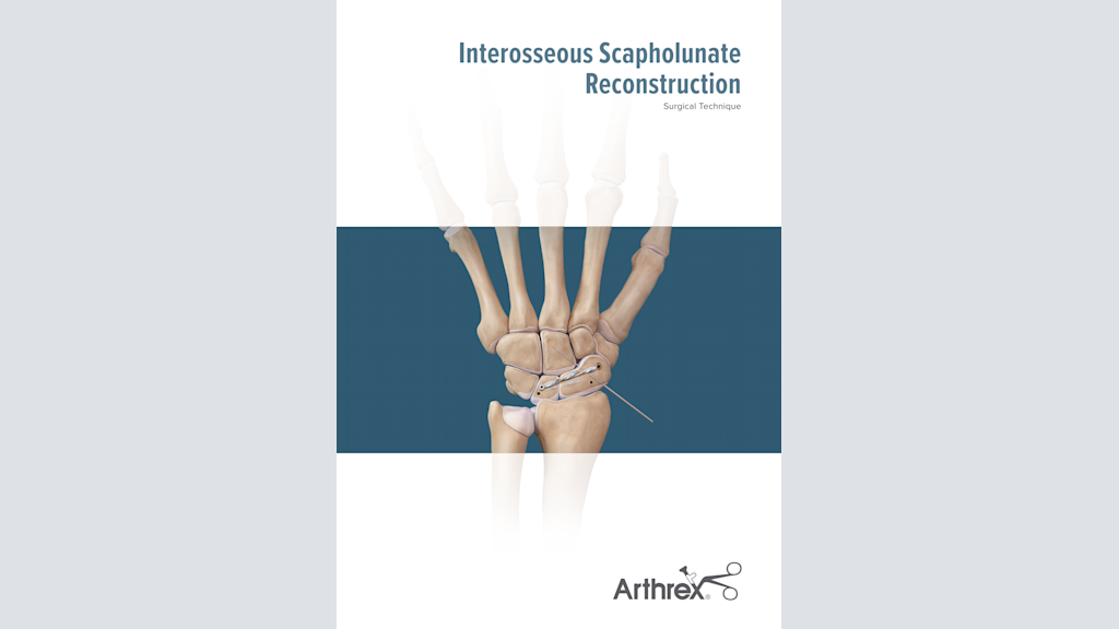 Interosseous Scapholunate Reconstruction