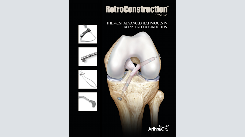 RetroConstruction™ System - The Most Advanced Techniques in ACL/PCL Reconstruction