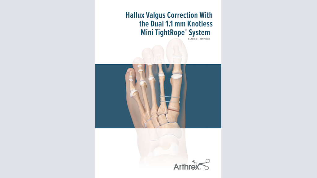Arthrex - Mini TightRope® Technique for Hallux Valgus