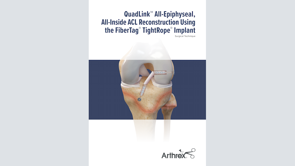 QuadLink™ All-Epiphyseal, All-Inside ACL Reconstruction Using  the FiberTag® TightRope® Implant
