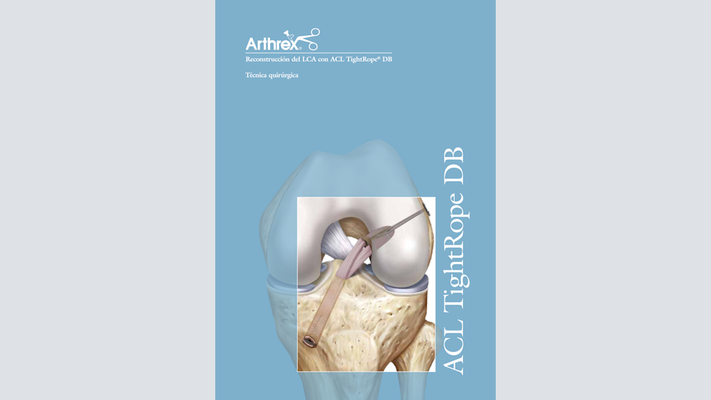 Reconstrucción del LCA con ACL TightRope® DB
