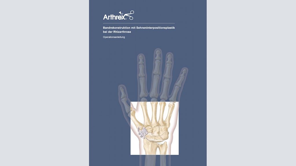 Bandrekonstruktion Sehneninterpositionsplastik bei der Rhizarthrose