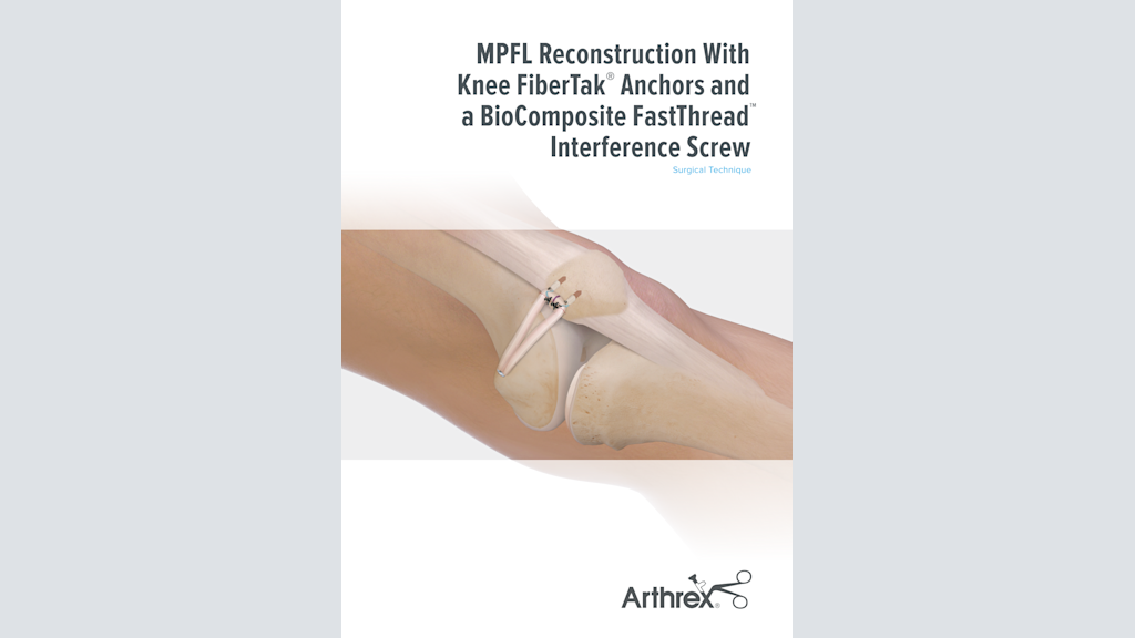 MPFL Reconstruction With Knee FiberTak® Anchors and a BioComposite FastThread™ Interference Screw