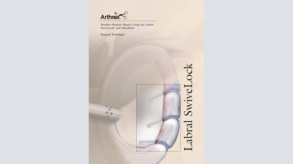 Knotless Bankart Repair Using the Labral SwiveLock® and FiberStick™