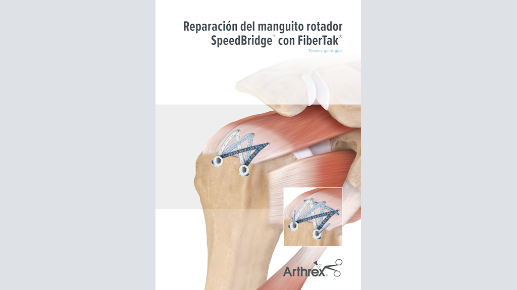 Reparación del manguito rotador SpeedBridge™ con FiberTak®