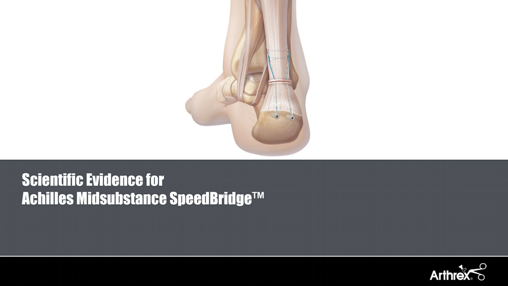 Arthrex - Achilles Midsubstance SpeedBridge™ Implant System