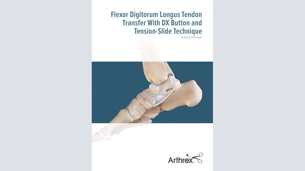 Flexor Digitorum Longus Tendon Transfer With DX Button and Tension-Slide Technique