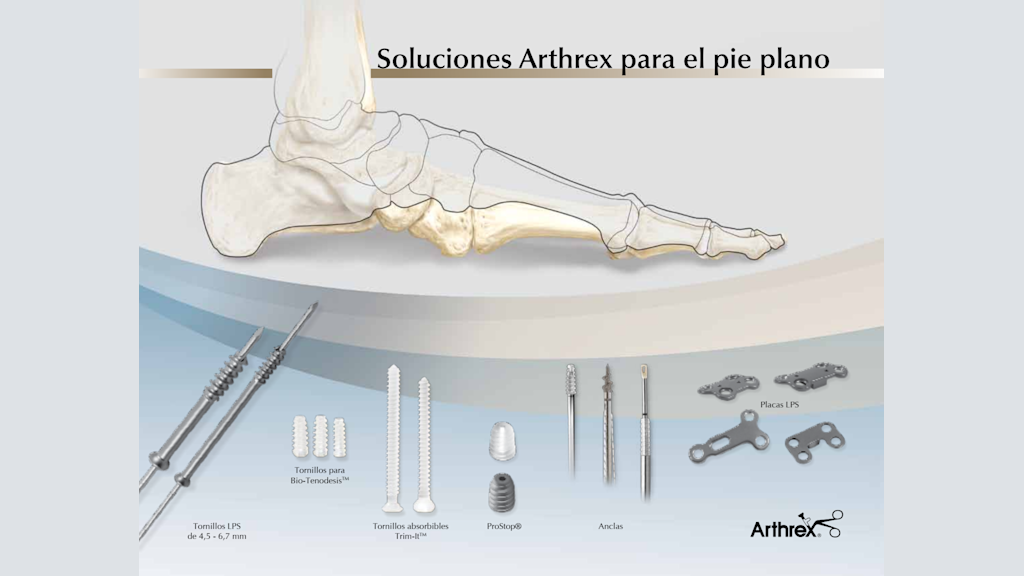 Soluciones Arthrex para el Pie Plano