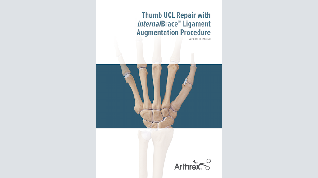 Thumb UCL Repair With InternalBrace™ Ligament Augmentation Procedure