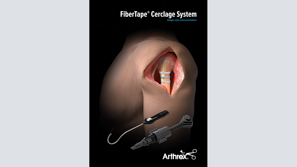 Arthrex FiberTape® Cerclage