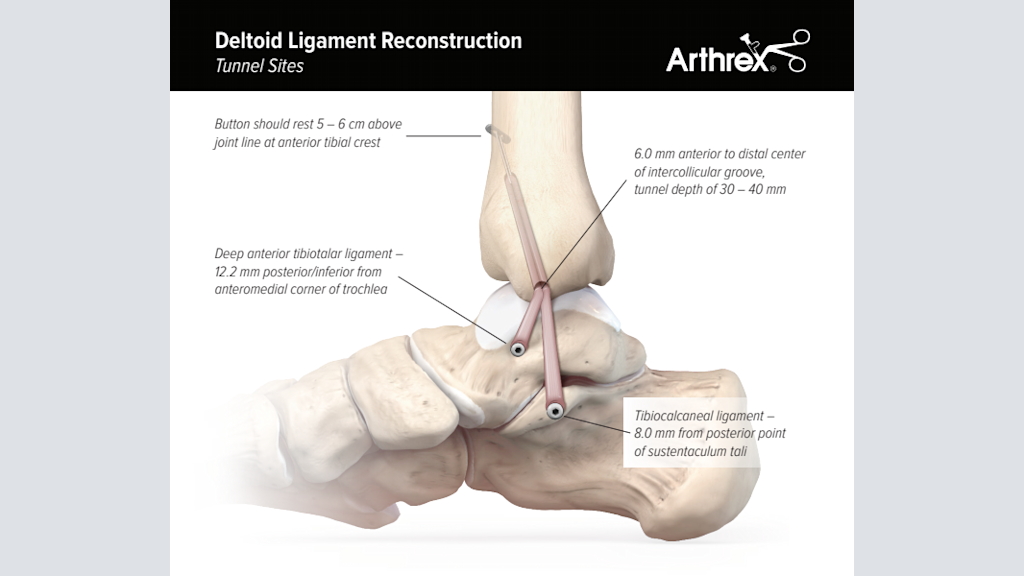 Deltoid Ligament Reconstruction