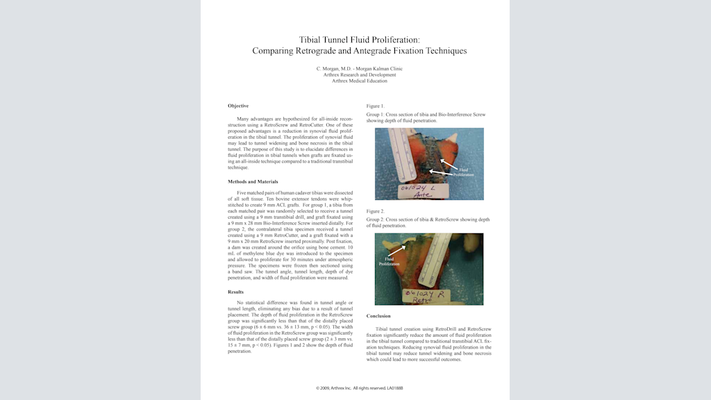 Tibial Tunnel Fluid Proliferation: Comparing Retrograde and Antegrade Fixation Techniques