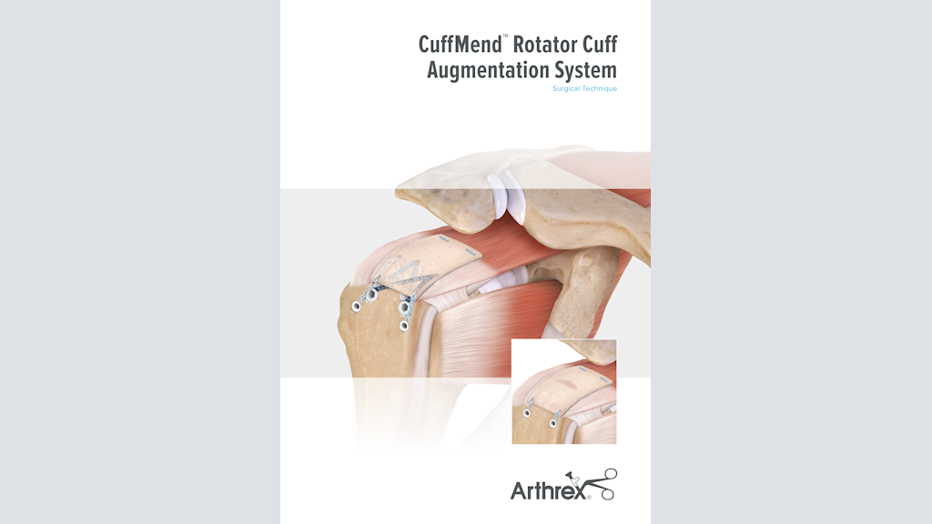 CuffMend™ Rotator Cuff Augmentation System