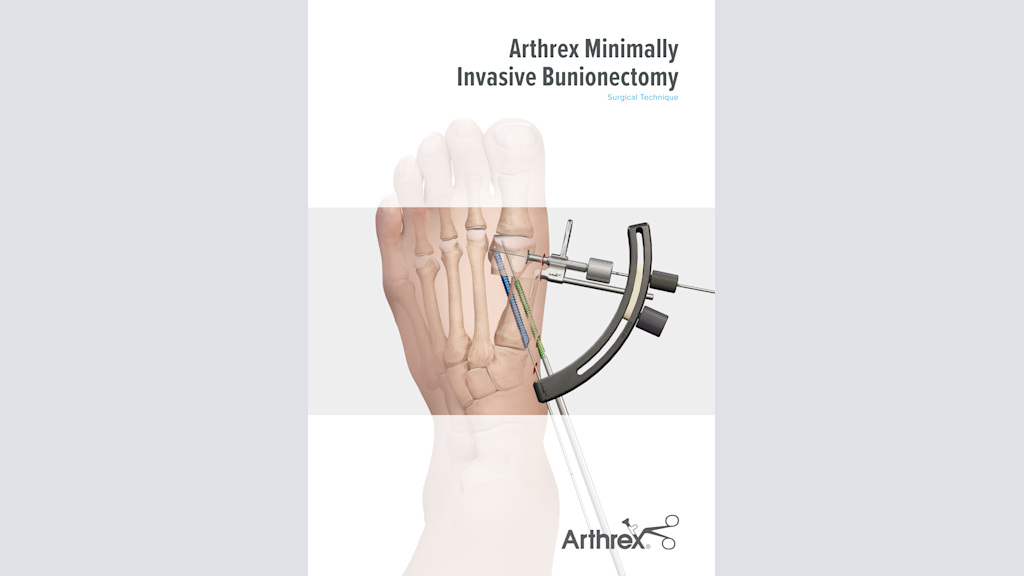 Arthrex Minimally Invasive Bunionectomy