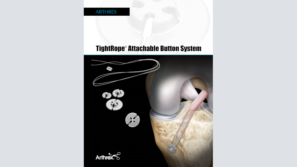 TightRope® Attachable Button System