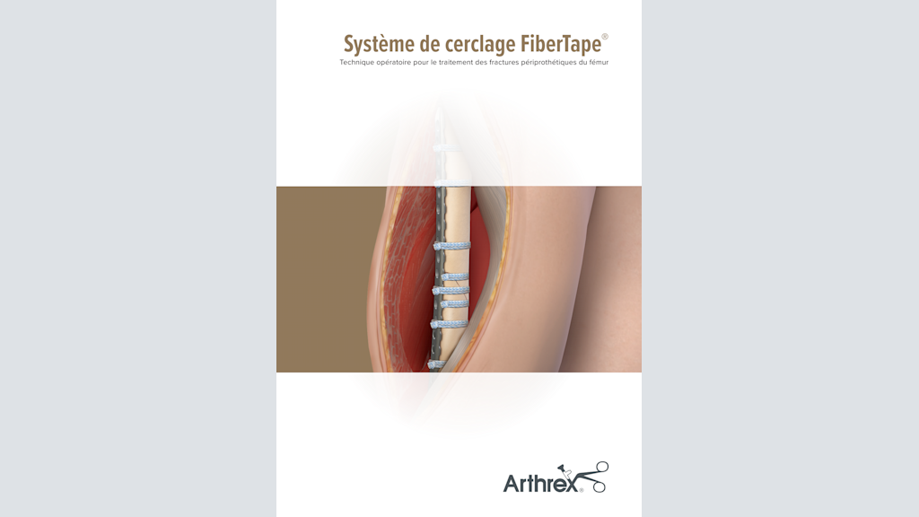 Système de cerclage FiberTape®