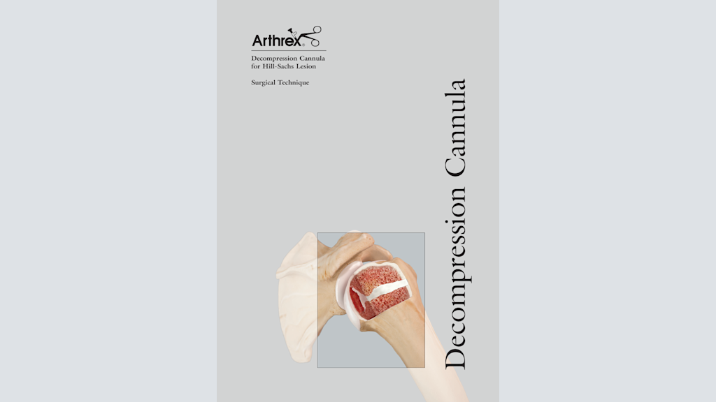 Decompression Cannula for Hill-Sachs Lesion