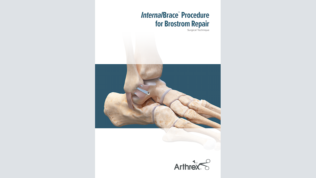 InternalBrace™ Procedure for Brostrom Repair