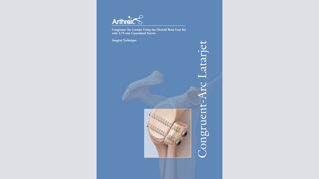 Congruent-Arc Latarjet Using the Glenoid Bone Loss Set with 3.75 mm Cannulated Screws