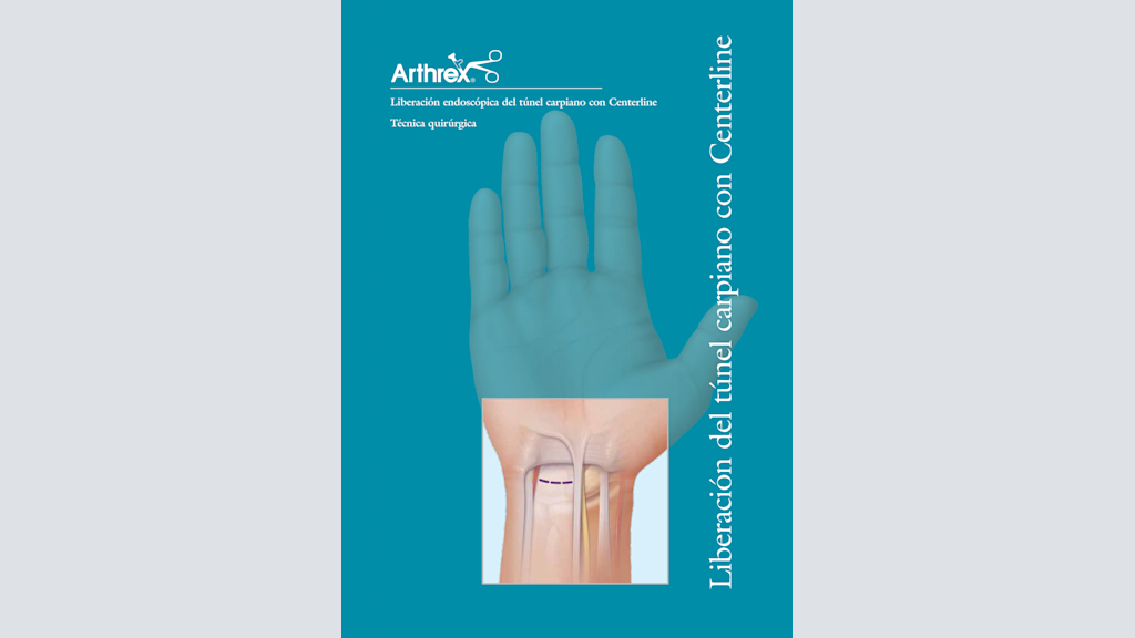 Liberación endoscópica del túnel carpiano con Centerline