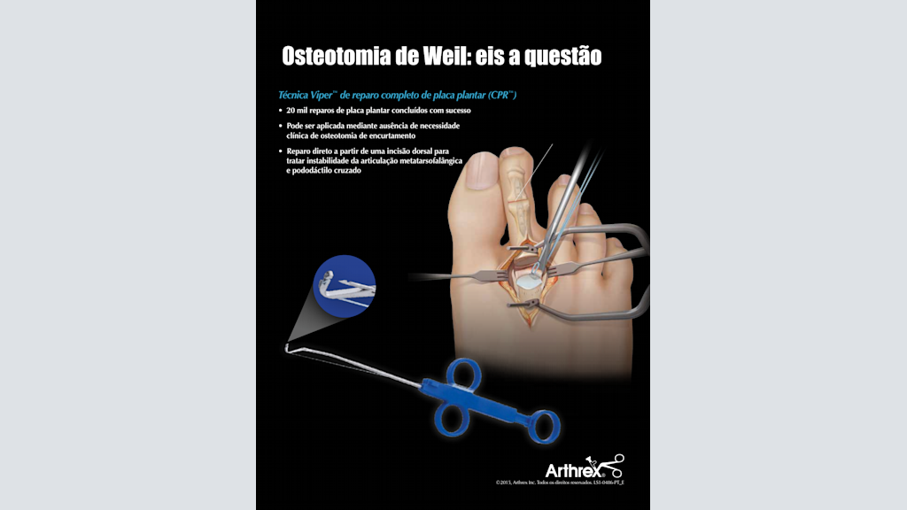 Osteotomia de Weil: eis a questão - Técnica Viper™ de reparo completo de placa plantar (CPR™)