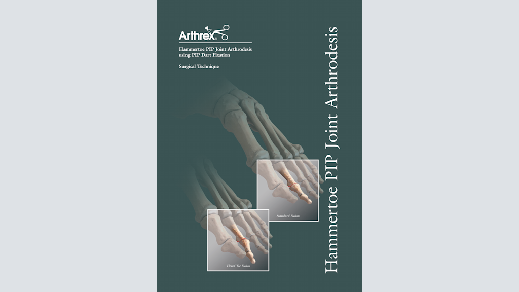 Hammertoe PIP Joint Arthrodesis using PIP Dart Fixation