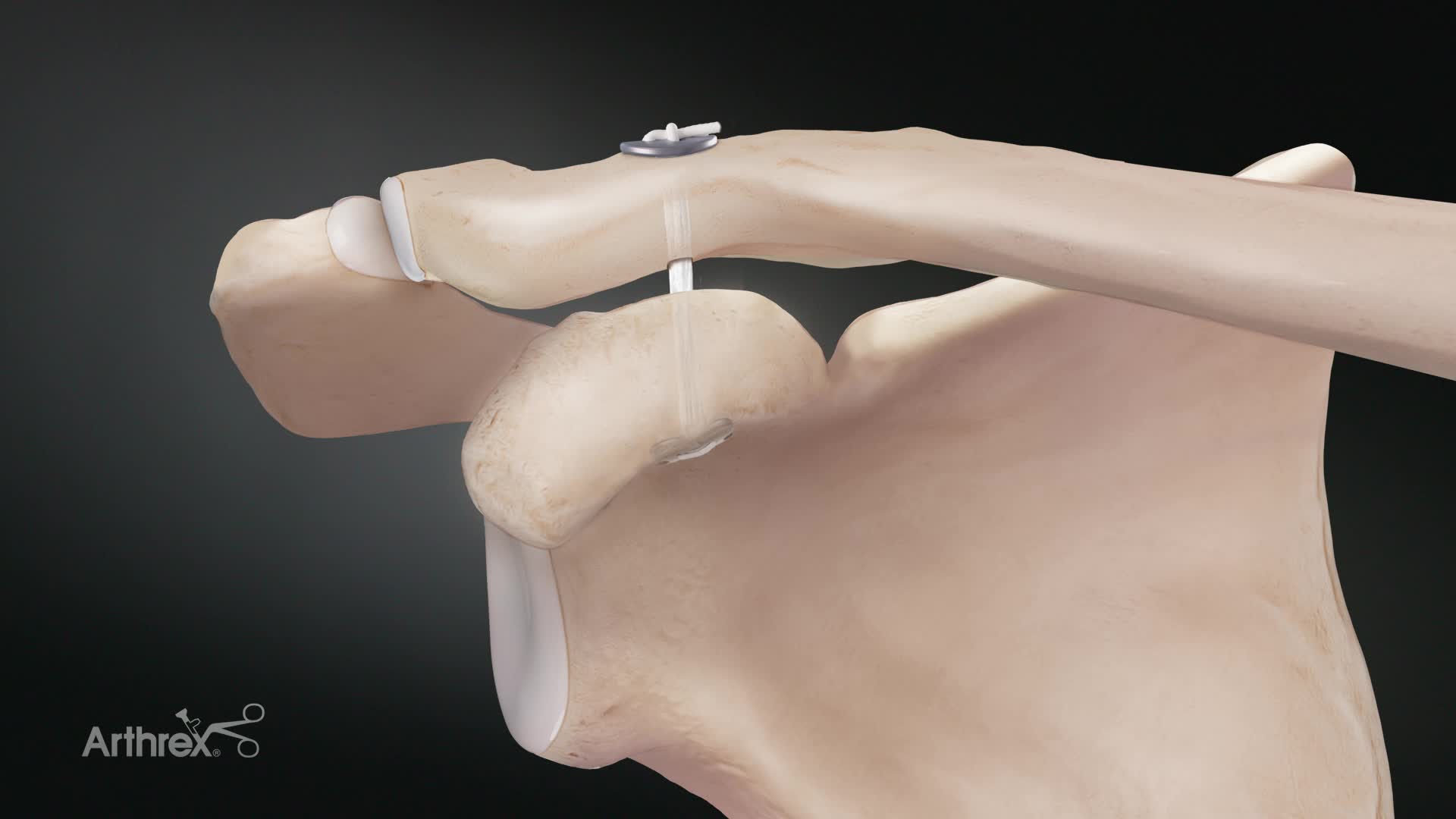 Arthrex - Acute AC Repair Using the Knotless AC TightRope® System