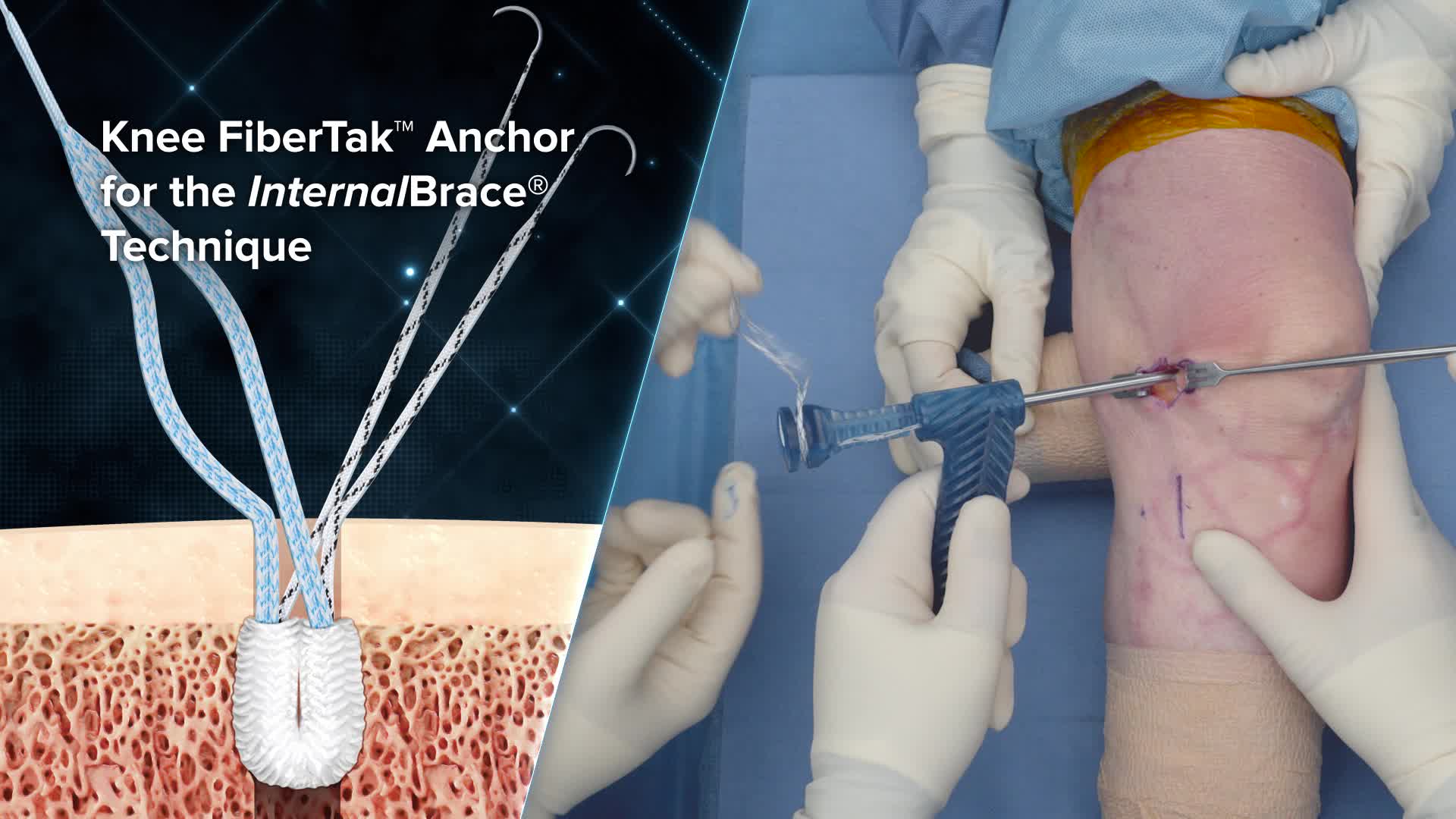Arthrex Knee FiberTak® Anchor With FiberTape® Suture for the