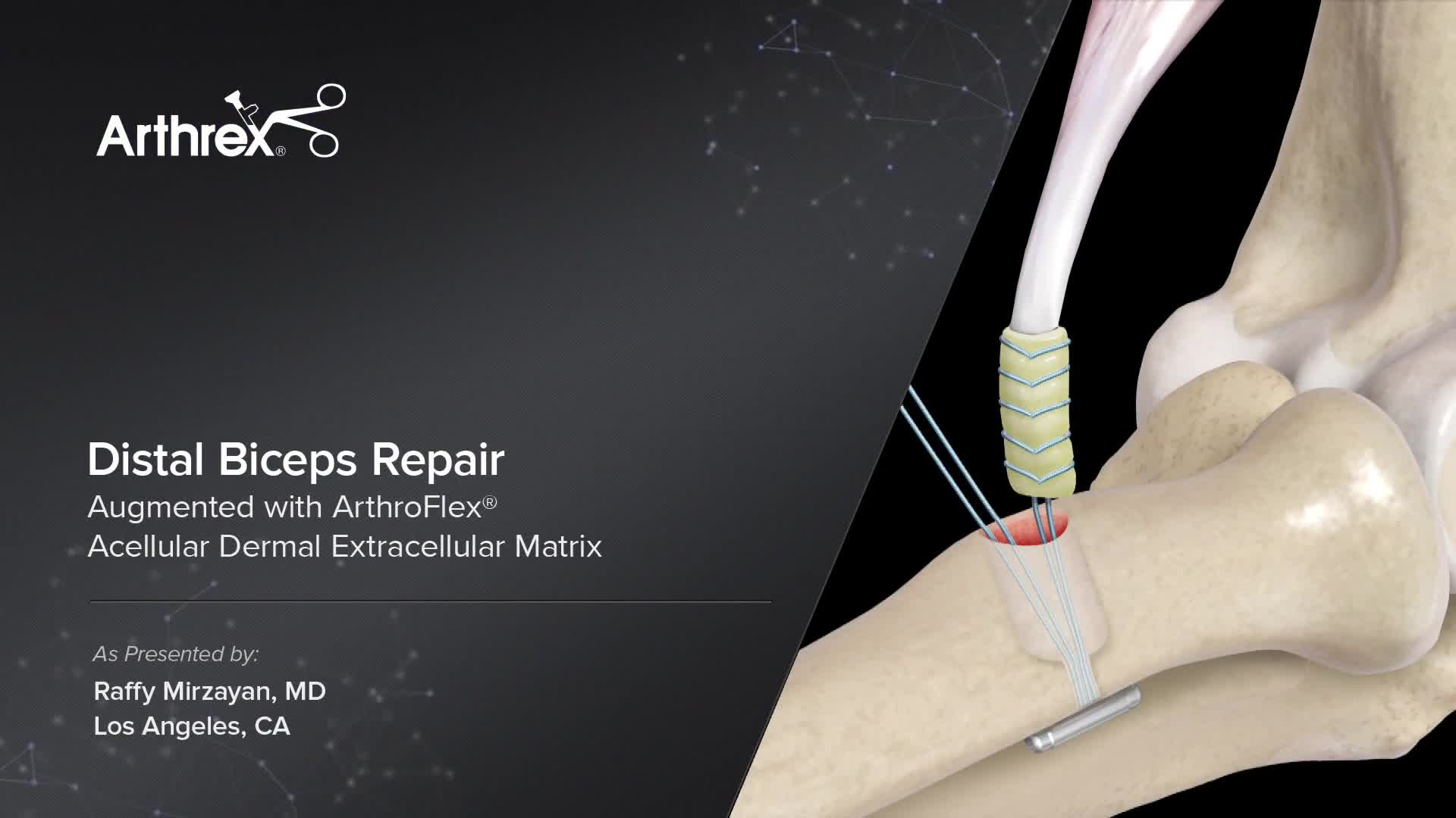 Arthrex - Distal Biceps Repair Augmented with ArthroFlex® Acellular ...