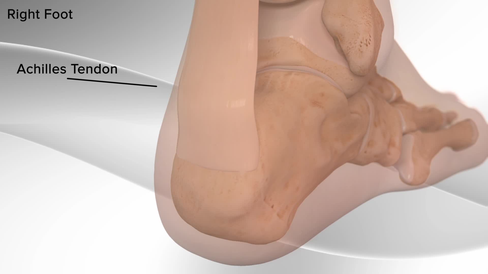 Arthrex - Achilles Tendon Repair with SpeedBridge™ System